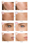 NUVEXO™ LED SKINMASK
    Máscara Facial LED 7 Colores